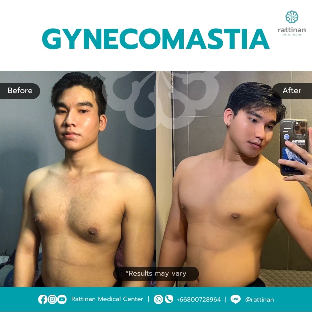 Gynecomastia Surgery in Thailand Before & After (3)