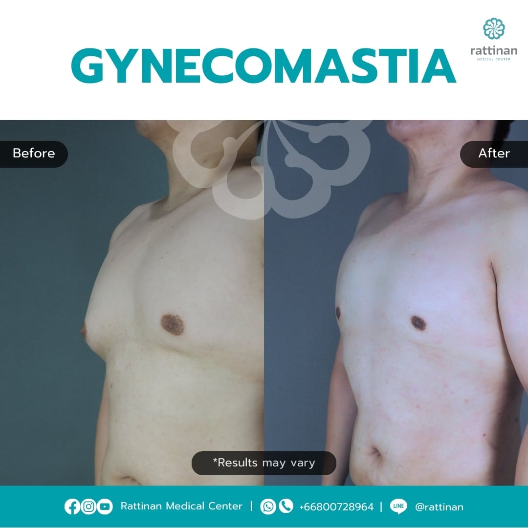 Gynecomastia Surgery in Thailand Before & After (4)