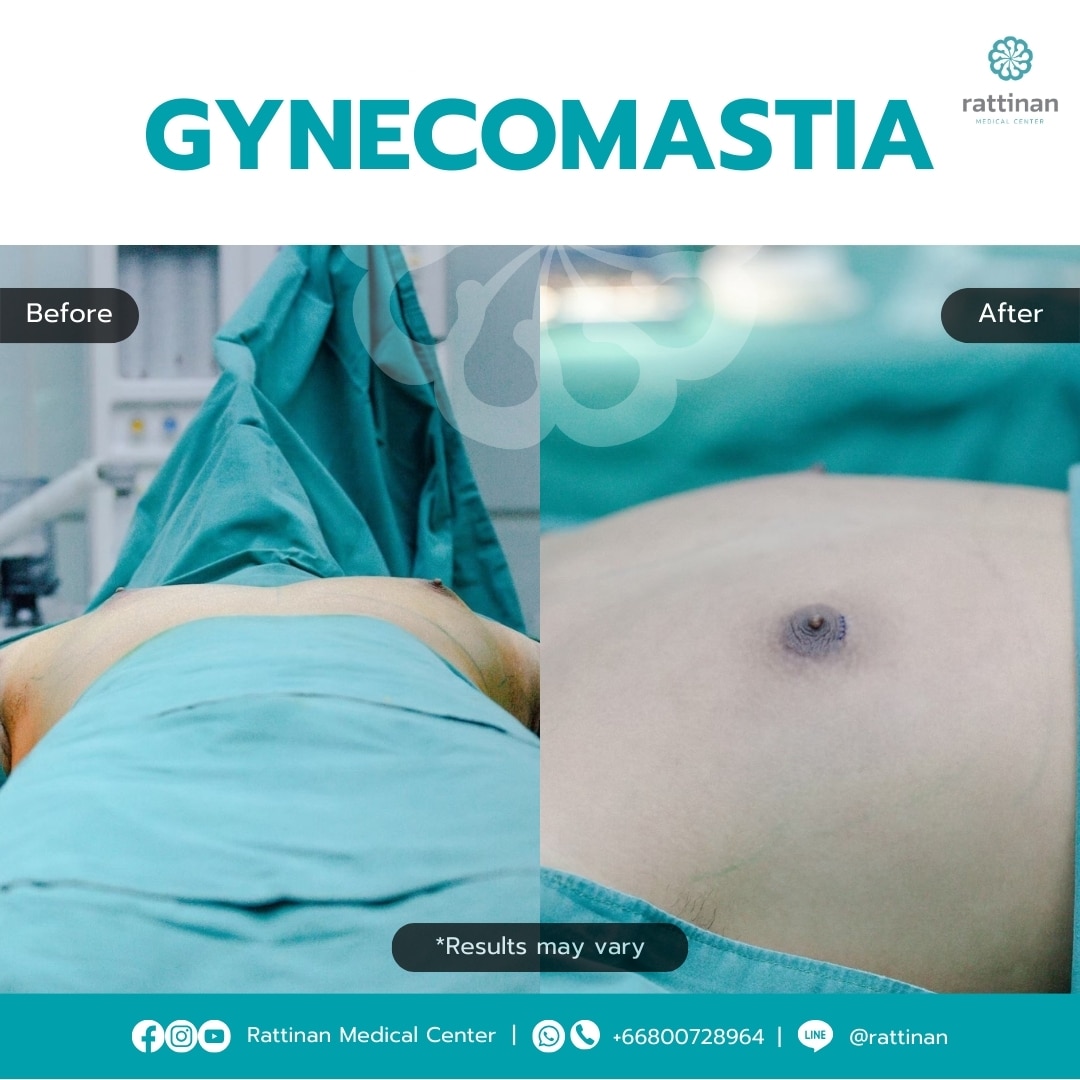 Gynecomastia Surgery in Thailand Before & After