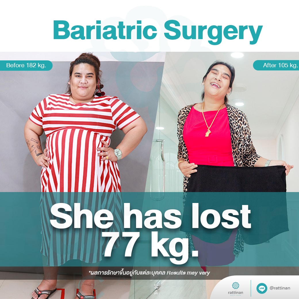 bariatric sergery review
