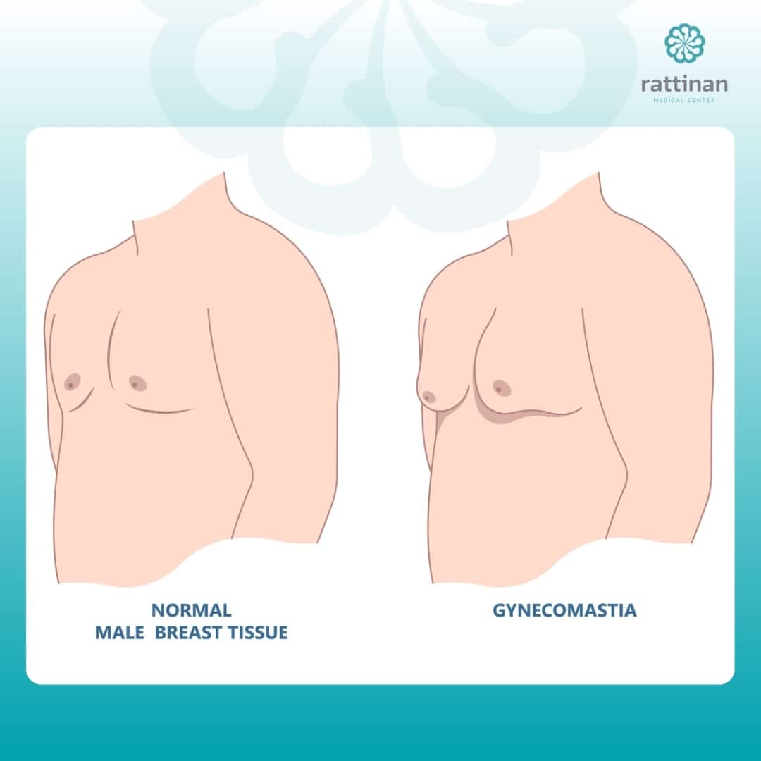 Gynecomastia Surgery in Thailand vs normal men boobs