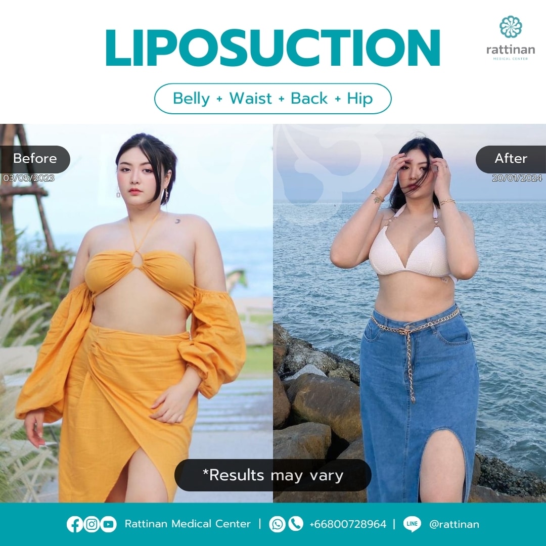 Liposuction in Thailand 4 points review