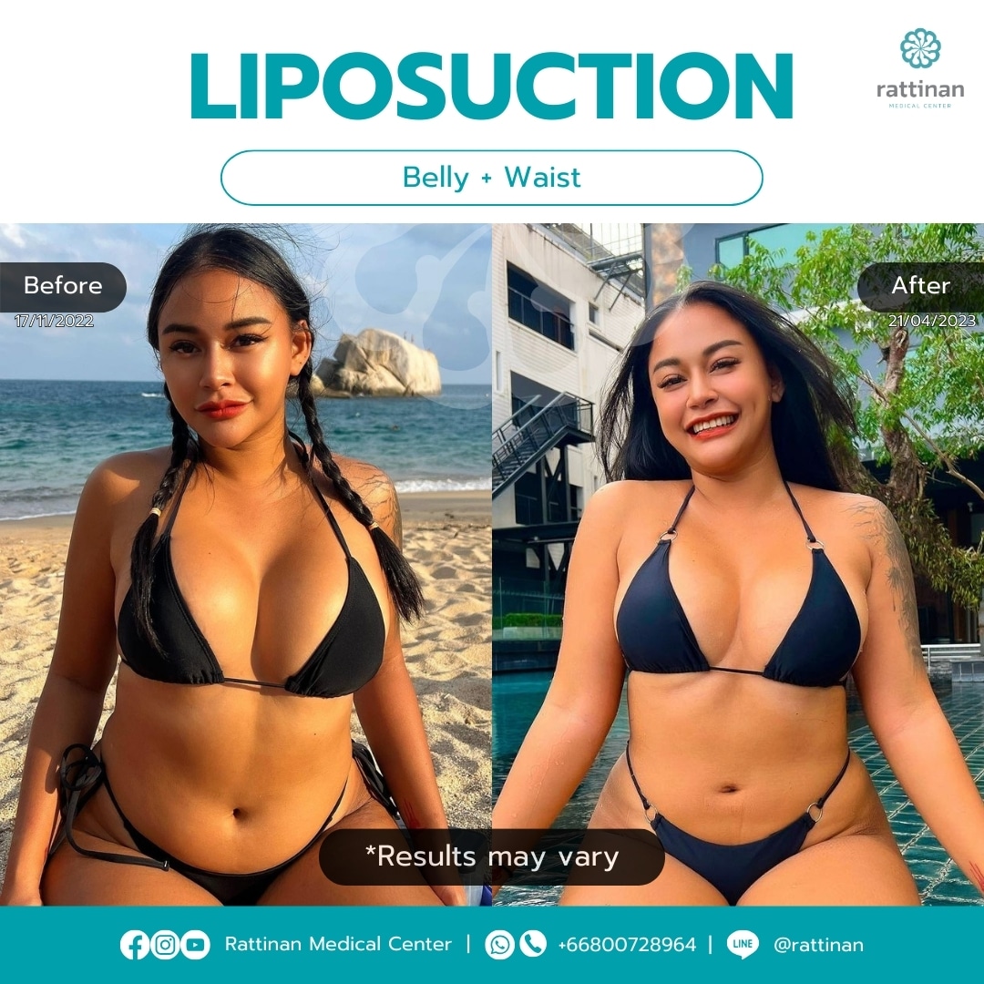 Liposuction in Thailand Belly and Waist