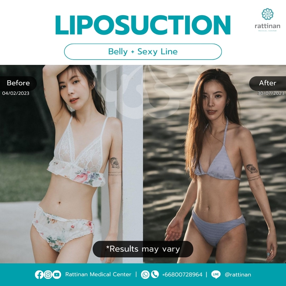 Liposuction in Thailand sexy line