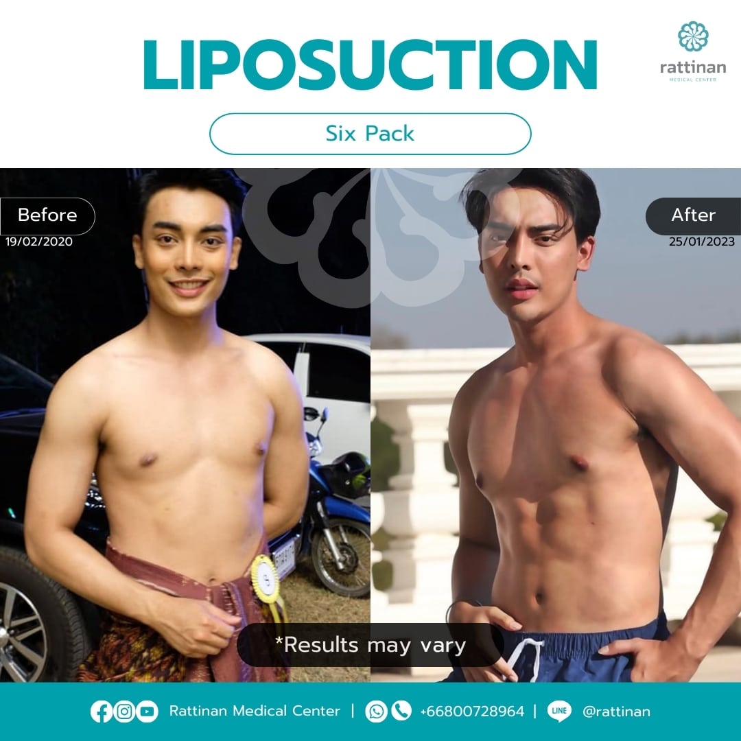 Liposuction in Thailand six pack