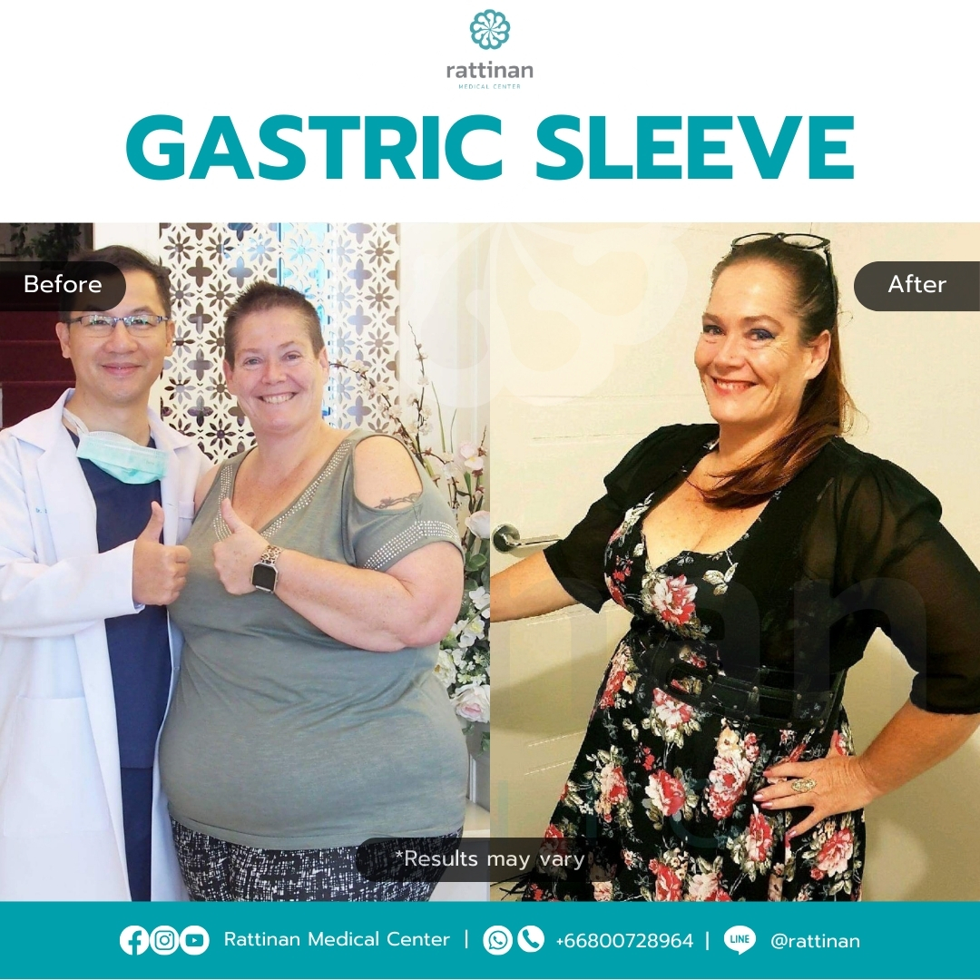 Gastric Sleeve Surgery In Thailand Rattinan Clinic