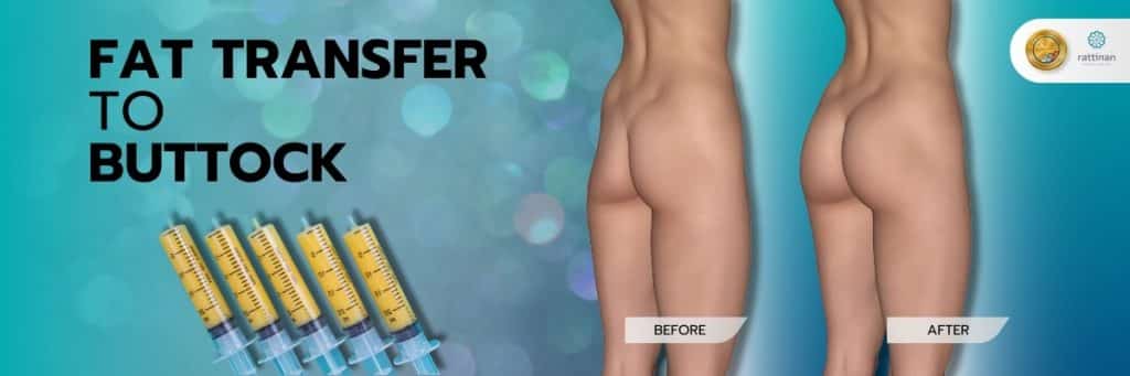 Buttock Augmentation FAQs