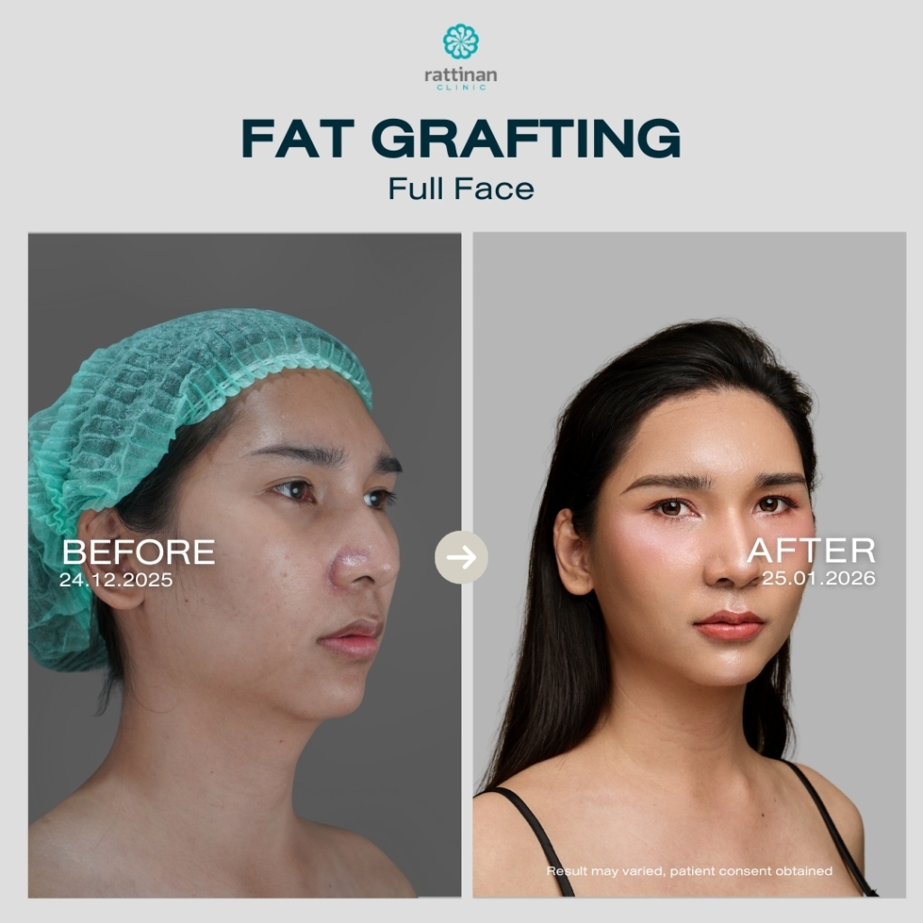 Fat Graph Fat Grafting in Thailand: What You Need to Know?