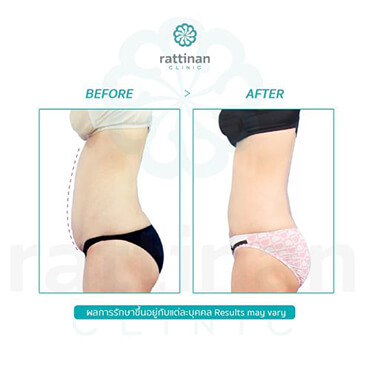 liposuction reviews