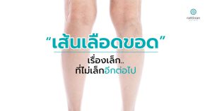 เส้นเลือดขอด - varicose veins