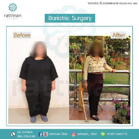 bariatric surgery reviews rattinan