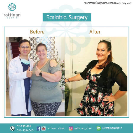 bariatric surgery reviews