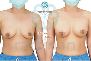 รีวิว ศัลยกรรมหน้าอก breast augmentation