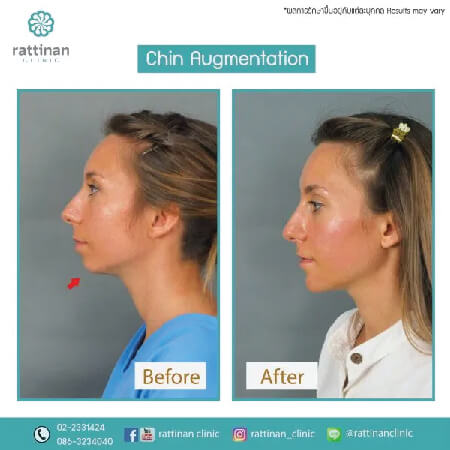 chin augmentation