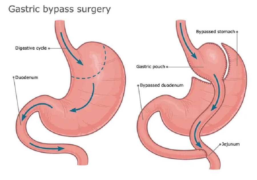 ผ่าตัดกระเพาะ รักษาโรคอ้วน แบบบายพาส