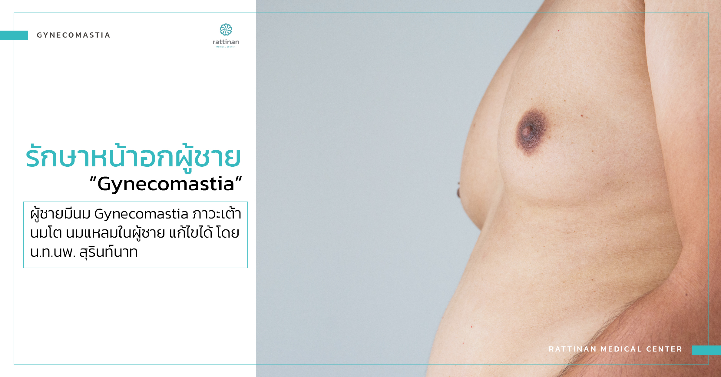 gynecomastia รักษาเต้านมโตผู้ชาย