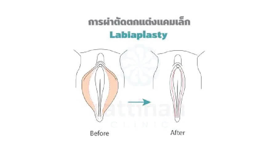 ผ่าตัดตกตแต่งเลเบีย labioplasty
