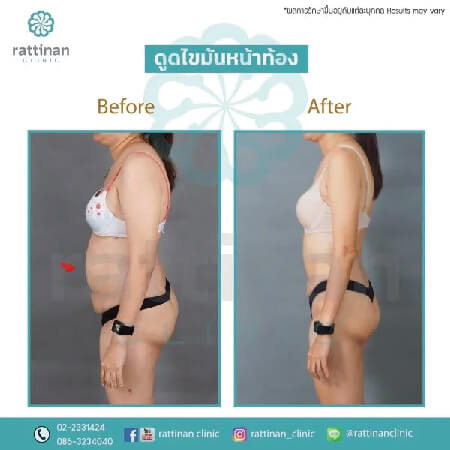 liposuction belly ดูดไขมันหน้าท้อง