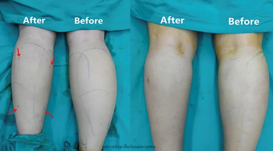 ก่อน-หลัง ดูดไขมันน่อง liposuction calf