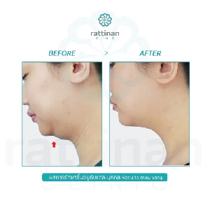 รีวิวดูดไขมันคาง liposuction chin