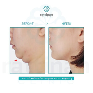 ก่อน-หลัง ดูดไขมันคาง liposuction chin