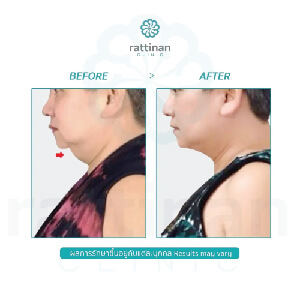 รีวิว liposuction chin