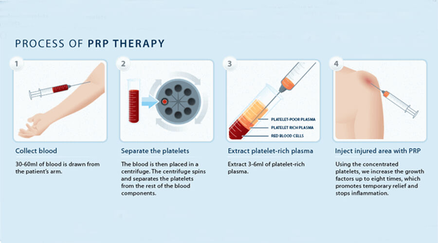 ขั้นตอนการรักษาด้วย PRP