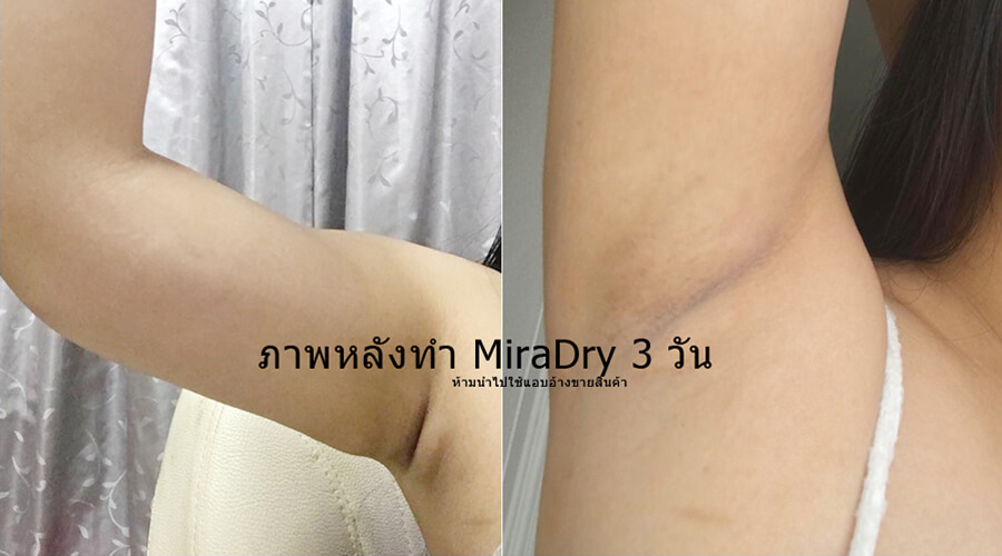 ก่อน-หลัง การทำ miraDry