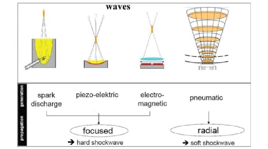 shock wave therapy