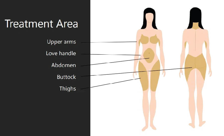 shock wave therapy ทำบริเวณใดได้บ้าง