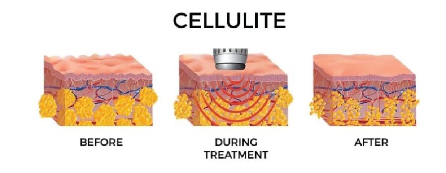 shock wave therapy ช่วยลดเซลลูไลท์