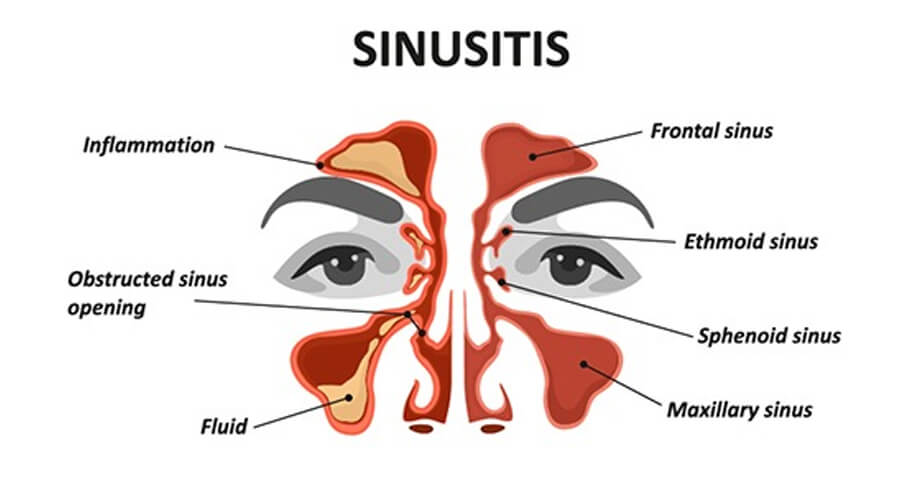 ไซนัสคืออะไร