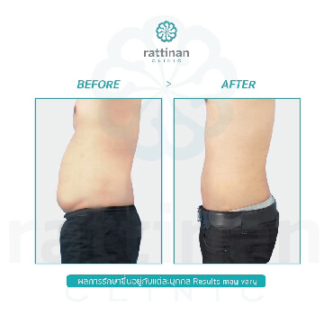 รีวิวผ่าตัดหนังหน้าท้อง tummy tuck ที่รัตตินันท์