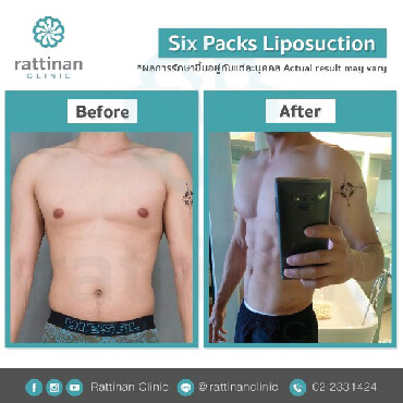 รีวิวดูดไขมันซิกแพค six pack รัตตินันท์ เมดิคอล เซ็นเตอร์