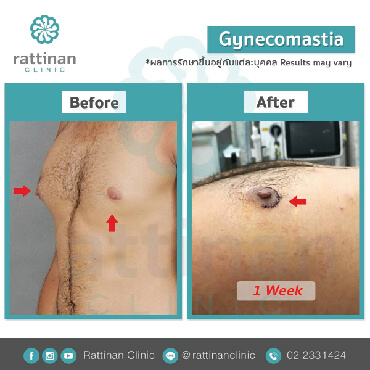 แผลผ่าตัด Gynecomastia