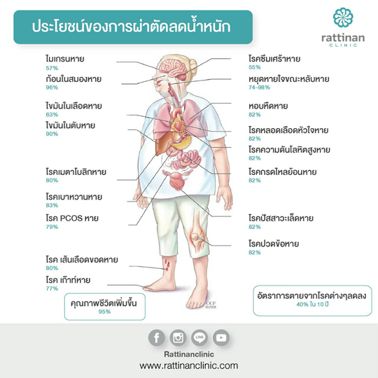 ประโยชน์ ผ่าตัดกระเพาะลดน้ำหนัก