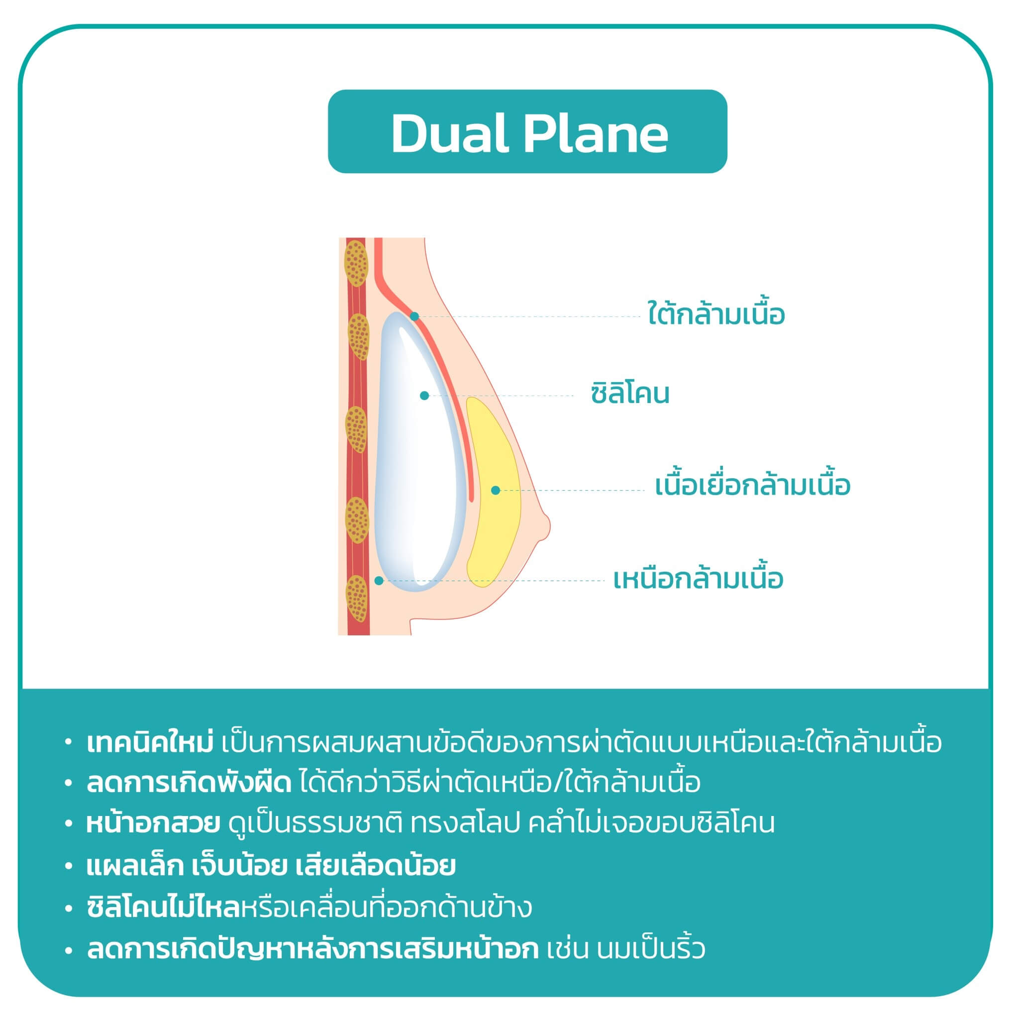 ศัลยกรรม เสริมหน้าอก เทคนิค ผ่าตัดระหว่างกล้ามเนื้อ หรือ Dual plane