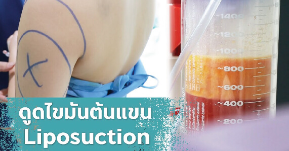 ดูดไขมันต้นแขน liposuction arms