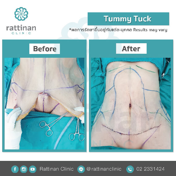 ตัดหนังหน้าท้อง tummy tuck ที่รัตตินันท์ เมดิคอล เซ็นเตอร์