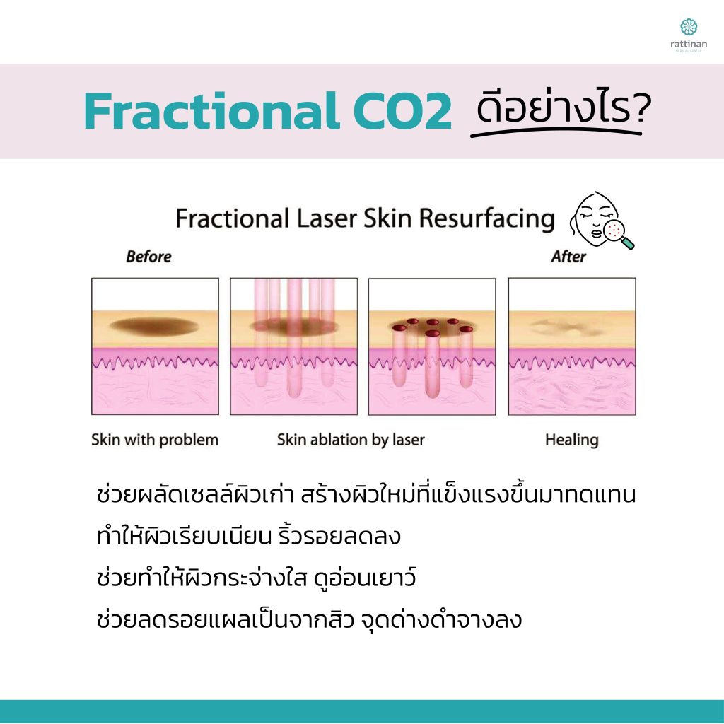 โปรแกรมเลเซอร์หลุมสิว ด้วย fractional co2