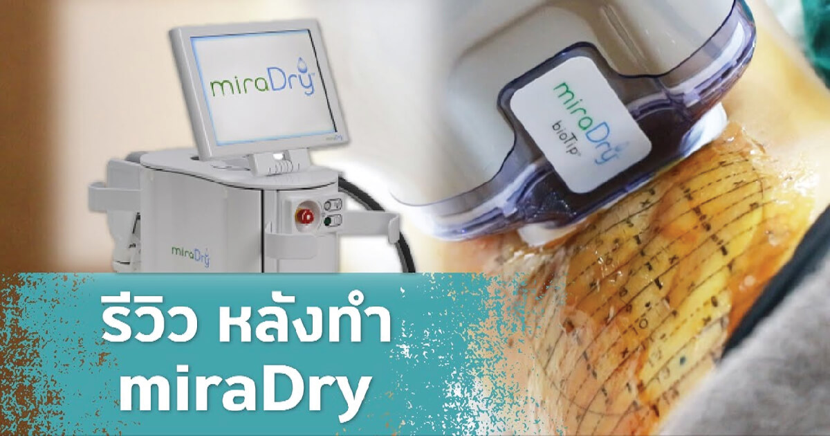 รวม รีวิว MiraDry ลดกลิ่นเหงื่อ แก้ปัญหากลิ่นตัว อย่างได้ผล Rattinan
