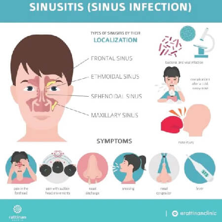 อาการไซนัส เป็นอย่างไร