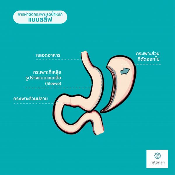 ผ่าตัดกระเพาะแบบสลีฟ sleeve bariatric surgery