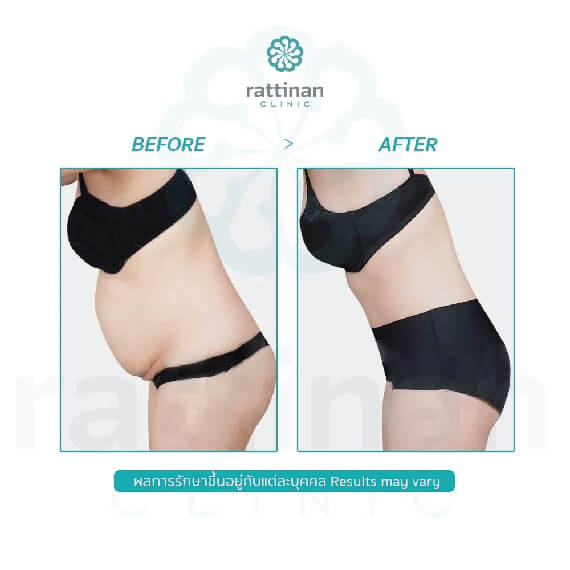 รีวิวผ่าตัดหนังหน้าท้อง tummy tuck