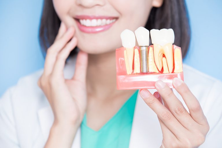 รากฟันเทียม กับ ฟันปลอม ต่างกันอย่างไร