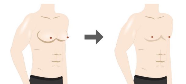 gynecomastia รักษาอย่างไร