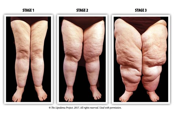 ภาวะโรคอ้วน ชนิด Lipedema