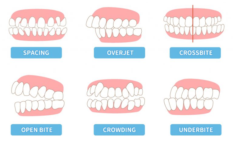 จัดฟัน ปัญหาฟันมีกี่แบบ