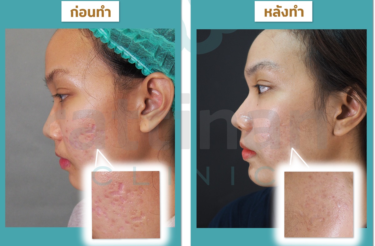 รีวิว skin booster ผิวแข็งแรง