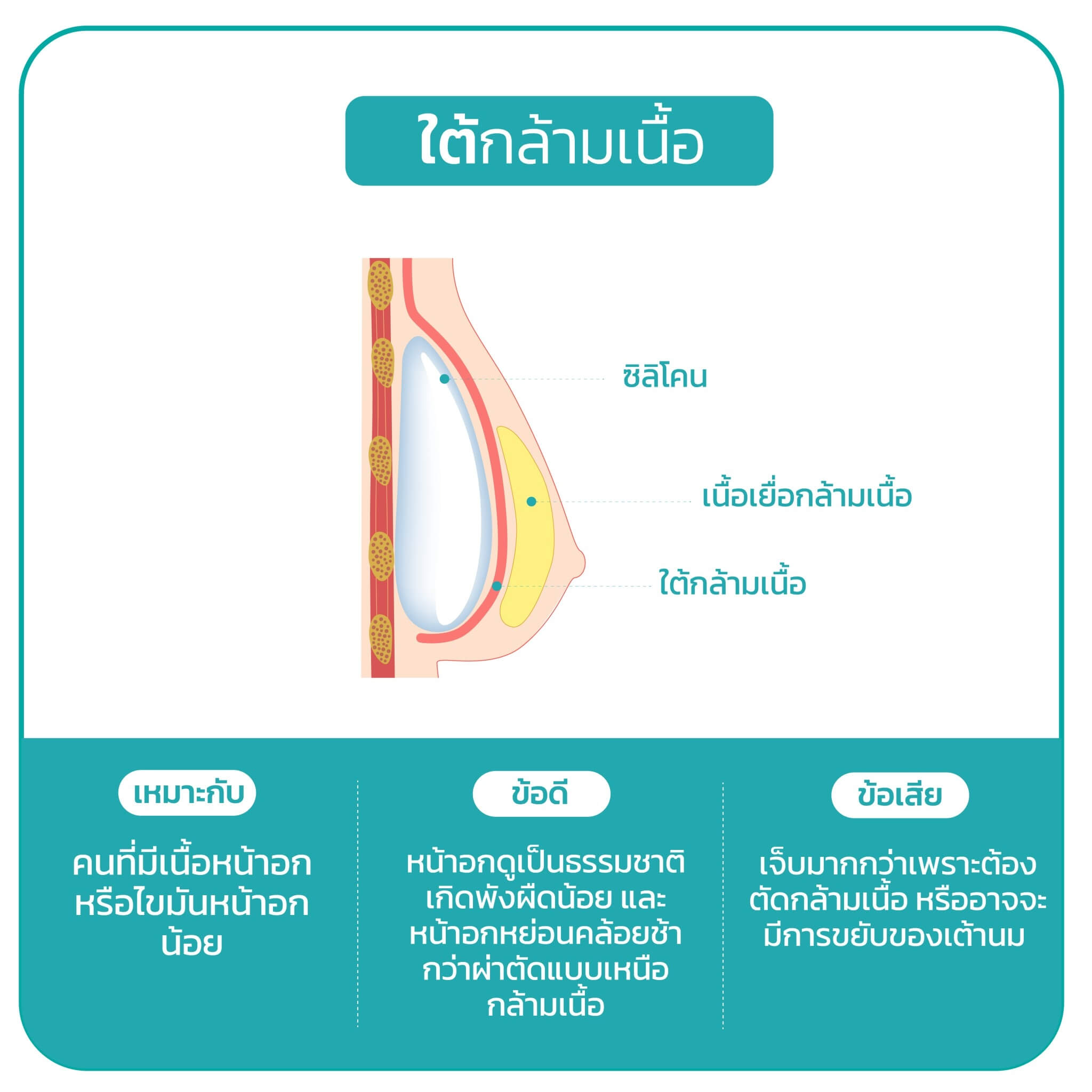 ศัลยกรรม เสริมหน้าอก เทคนิค ผ่าตัดใต้กล้ามเนื้อ